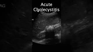 Acute Cholecystitis emergencymedicine surgery cholecystitis [upl. by Culhert493]