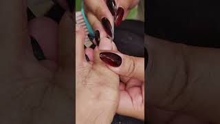 Toenail Ingrown Removal [upl. by Alexandra75]