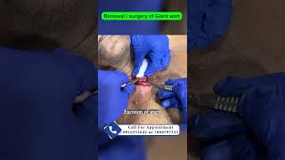 Removal  surgery of Giant wart  keratoacanthoma  wart का इलाज  Achil treatment Dr Uttam Lenka [upl. by Aihsenat643]