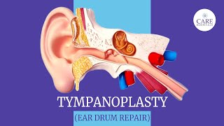 Eardrum Hole Repair Tympanoplasty  How it is done  After Tympanoplasty Care  CARE Hospitals [upl. by Stonwin]