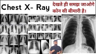 Chest X Ray  X Ray  X Ray Reading  Pneumonia  Lungs Effusion  X Ray Technician  Doctor  bhms [upl. by Ocana]