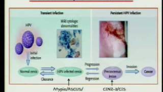 HPV and Cervical Cancer 25 Years from Discovery to Vaccine [upl. by Harris120]