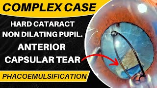 Complex case  Unintended Ant capsular tear Hard cataract pupil expansion device [upl. by Christabel113]