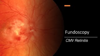 CMV Retinitis Fundoscopy [upl. by Margaretha561]