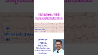 Old inferior wall myocardial infarction [upl. by Noach]