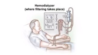 Dialysis Access and Fistula Procedure [upl. by Marceau]