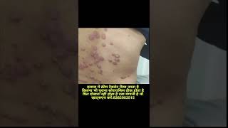 Psoriasis ka ilaaj [upl. by Ylime]