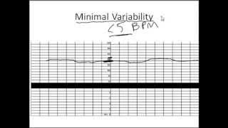 NonStress Test Made Simple [upl. by Walczak]