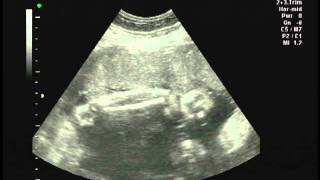 Ultrasound scan at 33 week pregnancy [upl. by Eelyma]