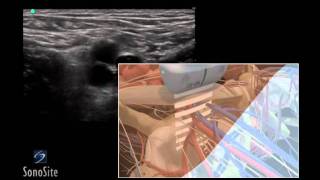 How To Ultrasound Guided Insertion of a Femoral Vein Catheter 3D Video [upl. by Seko632]