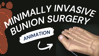 Minimally Invasive Bunion Surgery A Short Animation [upl. by Ailbert]