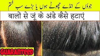 How to Remove Lice amp Egg Shells from Hair Permanently in One Day with Neem Paste Remedy [upl. by Virginie]