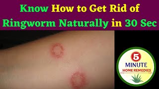 How to Get Rid of Ringworm Naturally  Home Remedy for Ringworm  Ringworm Treatment shorts [upl. by Hpesoj]