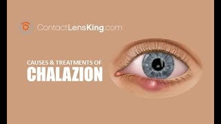 Chalazion  Causes Treatment and Surgery [upl. by Sternberg96]