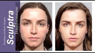 SCULPTRA The Liquid Facelift  Pearlman Aesthetic Surgery [upl. by Geordie913]