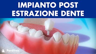 Impianto dentale immediato postestrazione dente © [upl. by Winni]