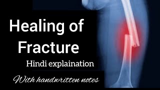 Fracture healing  Stages of Fracture healing  Hindi explaination  Easy learning [upl. by Aokek]