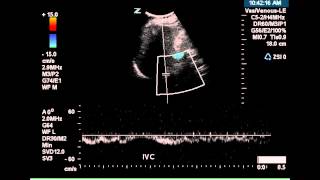 Renal Vein Doppler  Case Study [upl. by Liggett]