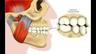 Rechinido dental [upl. by Lenahs]