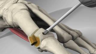 First Metatarsal Distal Chevron Osteotomy with Arthrex® LPS Screw [upl. by Aissat846]