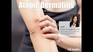 Atopic Dermatitis VisualDx Clinical Education Series [upl. by Maghutte]