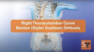 What is a Right Thoracolumbar Scoliosis Curve Boston Style [upl. by Frank]