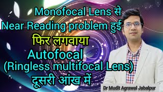 Unsatisfied Patient with MONOFOCAL LENS After Cataract Surgery Chooses AUTOFOCAL Lens for Other Eye [upl. by Barbarese]