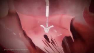 New treatment for severe mitral regurgitation by cardiologist Lee MacDonald MD MitraClip [upl. by Ellehsad]