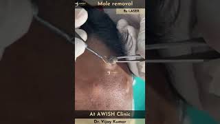 Mole on forehead Removal by RF  Painless mole removing mole remove moles awishclinic shorts [upl. by Erbua220]