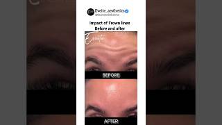 What are the impact of Frown lines Before and AfterHow its look on your facecosmeticsurgery [upl. by Aisercal]