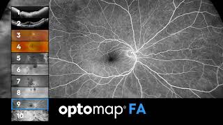 optomap  10 imaging modalities [upl. by Cavil]