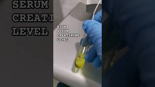 High Serum Creatinine Level chemistry laboratory cls medtechstudent mls bloodtest bloodchem [upl. by Divadnahtanoj]