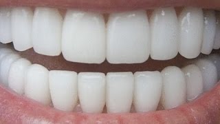 HOW TO HAVE NATURAL WHITE TEETH IN 3 MINUTES  WORKS 100 [upl. by Siraf655]