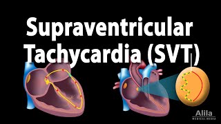 Supraventricular Tachycardia SVT PSVT Animation [upl. by Turnbull]