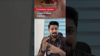 കൺപോള തുടിക്കൽ Kanpola Thudikkalmyokymia or eyelid twitchmalayalam kerala eyes eyelid health [upl. by Marquis]