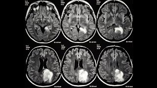 Brain Tumor Classification using Convolution Neural Network Tensorflow918283834812 for query [upl. by Brigg]