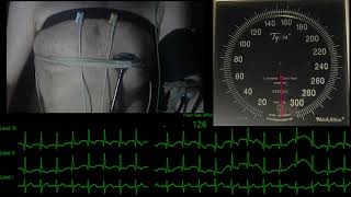 Male Tachycardia Heartbeat with ECG 3leads and BP exam [upl. by Rentsch535]