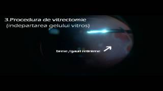 Operatie de vitrectomie pe un ochi cu dezlipire de retina regmatogena [upl. by Coppola]