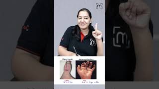 1 minute learning Osler Node and Janeway Lesion  MedLive  Dr Priyanka Sachdev [upl. by Yborian]