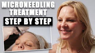 The Ultimate Microneedling Facial For Flawless Skin  Microneeedling Treatment Stepby Step [upl. by Thorr]