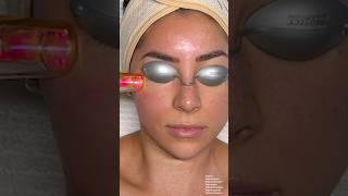 ASMR Facial Laser Treatment on Jeanine Amapola [upl. by Torray420]