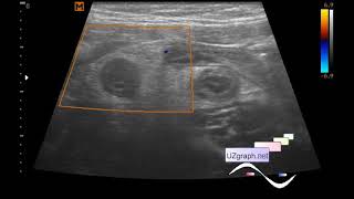 Ecografía abdominal pediátrica apendicitis flemonosa aguda omentitis [upl. by Solrak598]