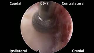 Full Endoscopic Stenosis Cervical Decompression [upl. by Flodnar545]