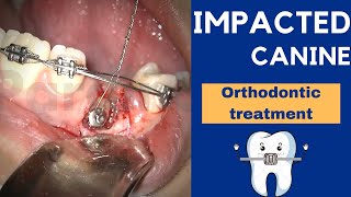 IMPACTED CANINE exposure treatment with ORTHODONTICS and braces  Step by step [upl. by Eneloj766]