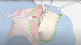 IPS® Transformation  Facial Feminization Surgery [upl. by Aelber]