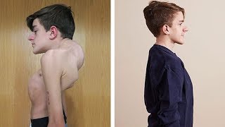 John Sarconas Testimonial  Overcoming Severe Scoliosis and Kyphosis [upl. by Redan139]