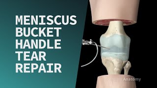 Meniscus Bucket Handle Tear Repair [upl. by Yesllek]