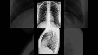 DESCRIPCION RADIOLOGIA DE PATRON NORMAL DE RADIOGRAFIA DE TORAX [upl. by Noami]