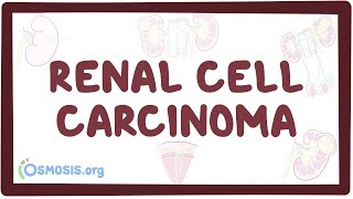 Renal cell carcinoma  an Osmosis Preview [upl. by Eglantine62]