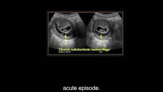 Ultrasound of the first trimester Part 2 Level 1 [upl. by Engapmahc]